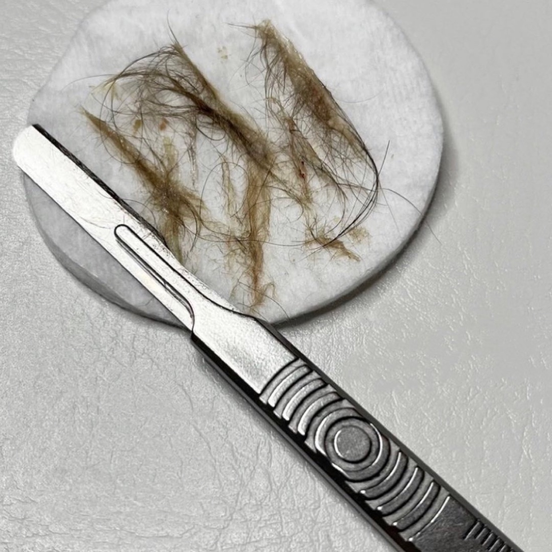 Dermaplaning blade and removed vellus hair