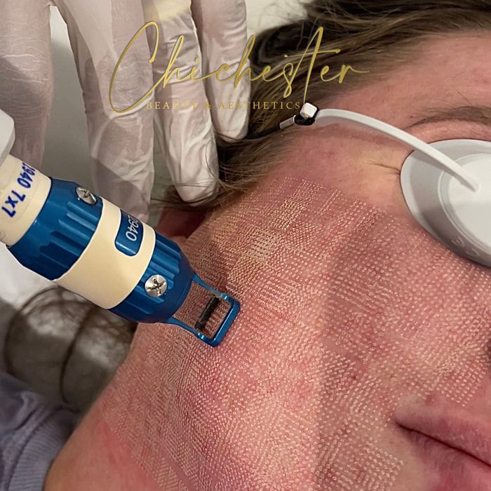 Laser treatment with protective eyewear in place